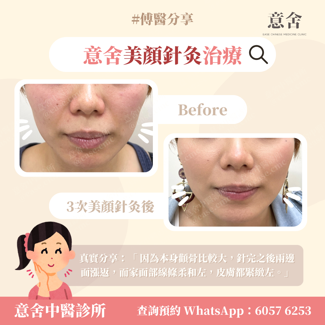 美顏針灸治療