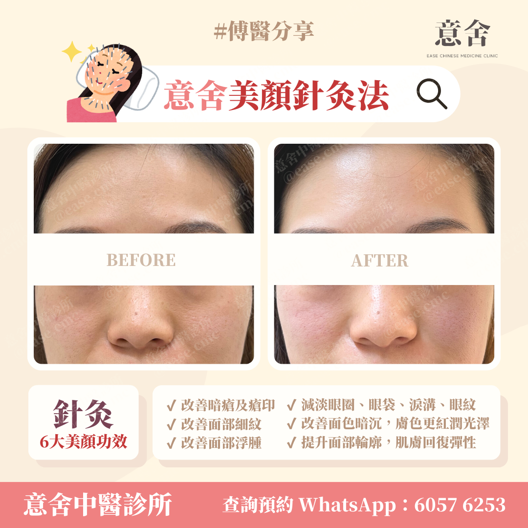 美顏針灸效果