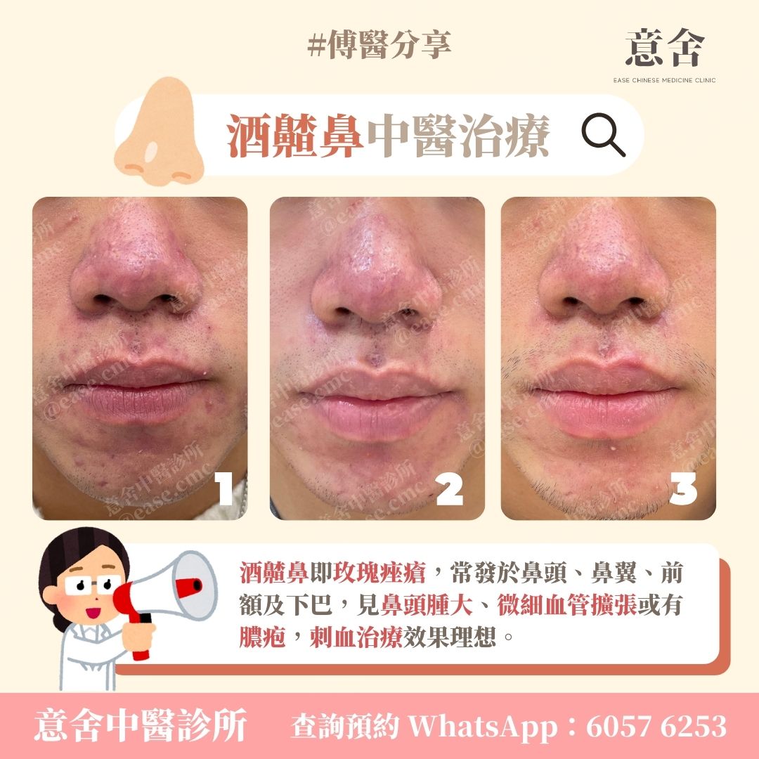 玫瑰痤瘡可以根治嗎?中醫如何治療? - 意舍中醫診所