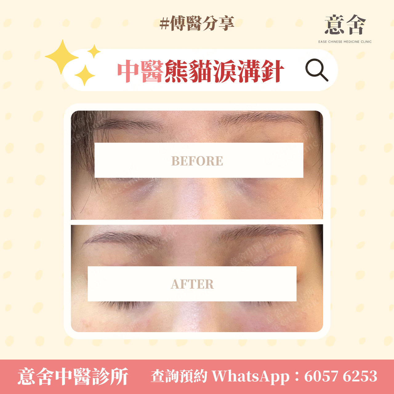 熊貓針灸治療