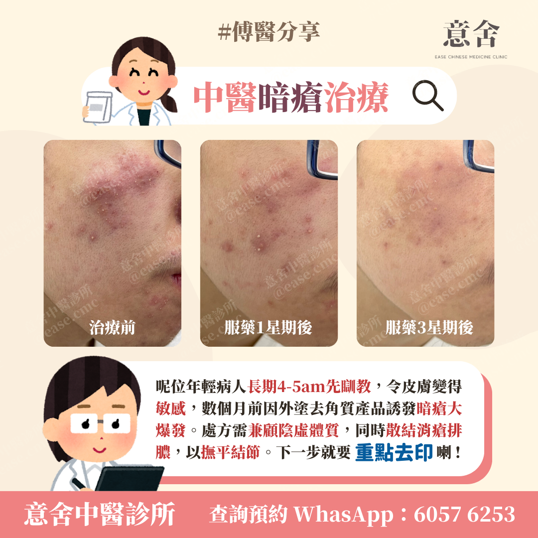 撫平結節型暗瘡