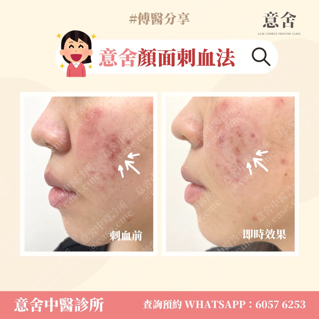 美顏刺血