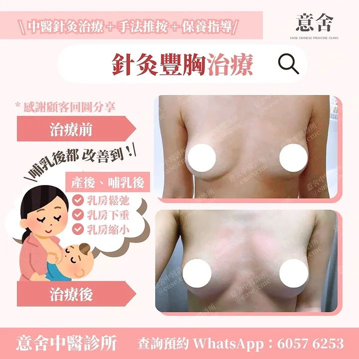 針灸豐胸