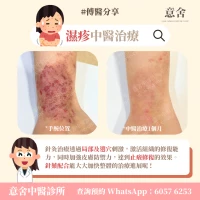 濕疹中醫治療