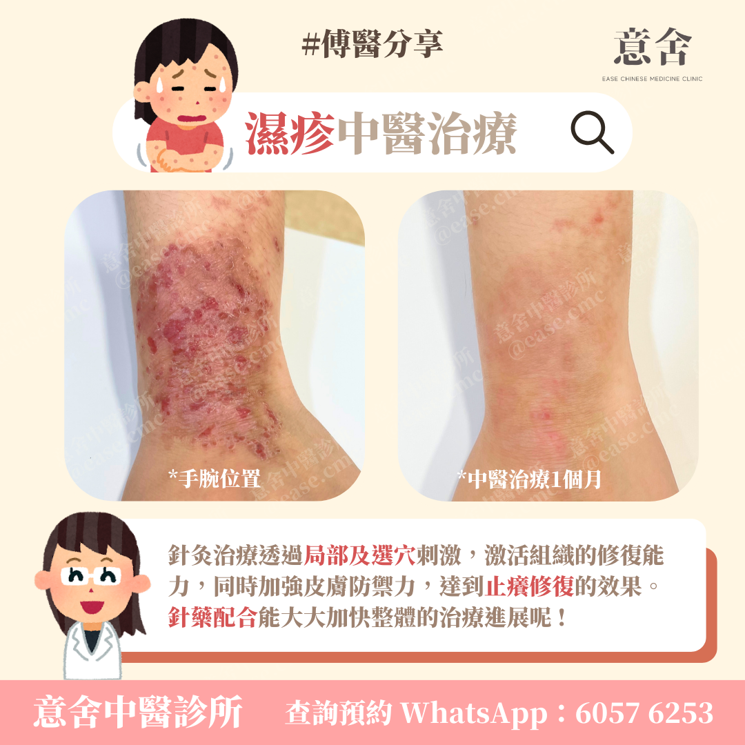 濕疹中醫治療