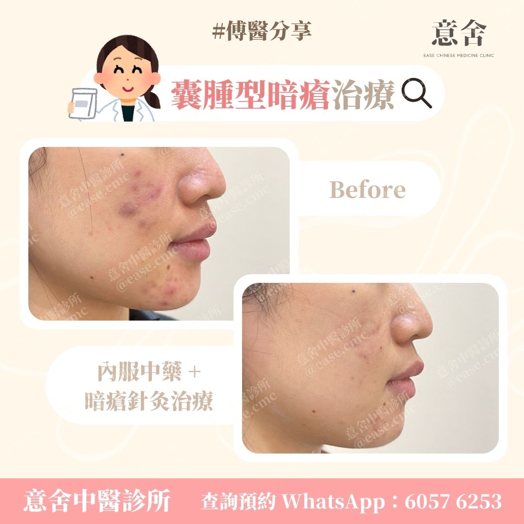 暗瘡的分型及治療方法