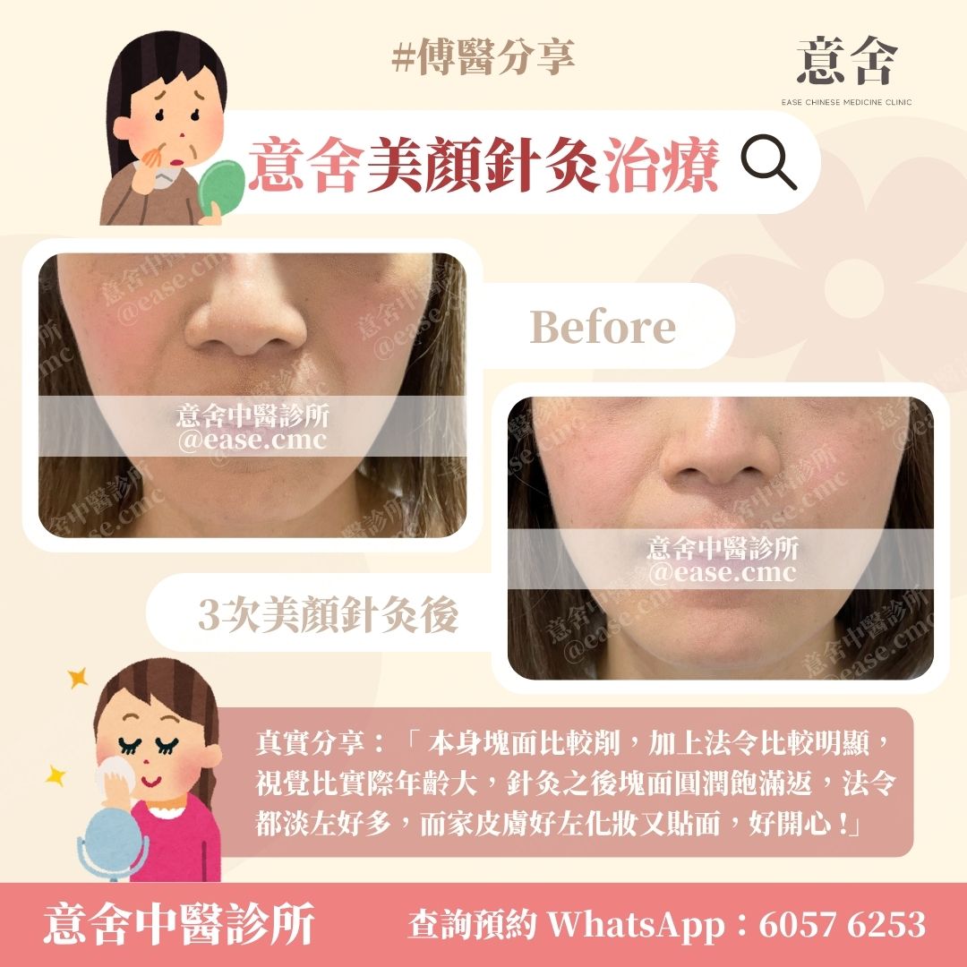美顏針灸
