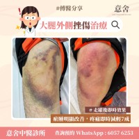 大腿外側挫傷治療