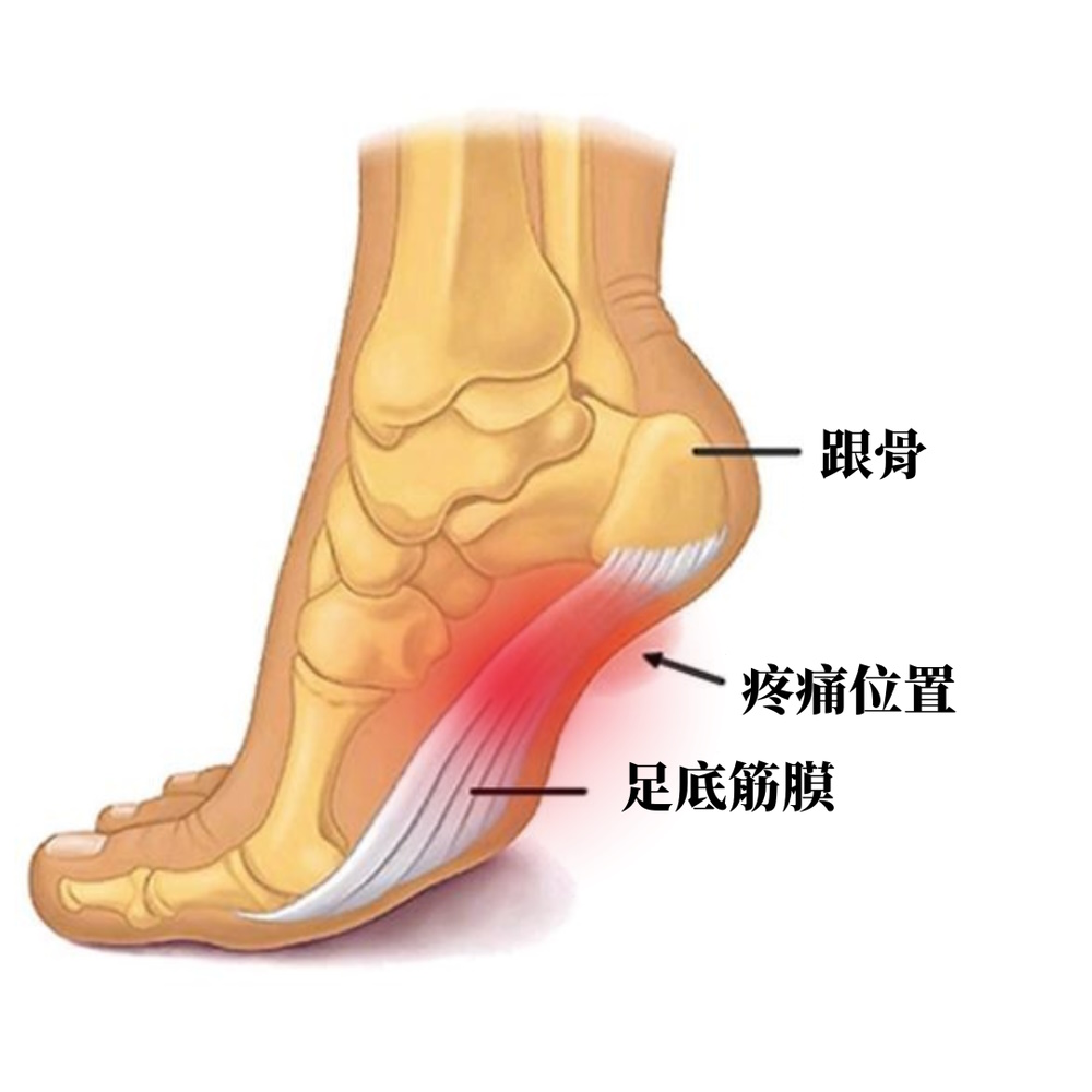 足底筋膜炎位置 肩周炎成因