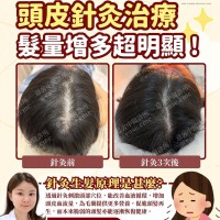 頭皮針灸治療案例