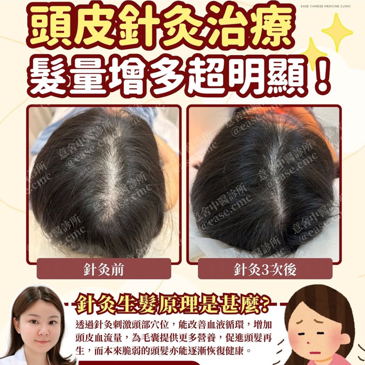 頭皮針灸治療案例