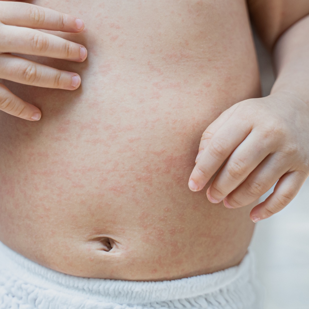 熱痱及濕疹