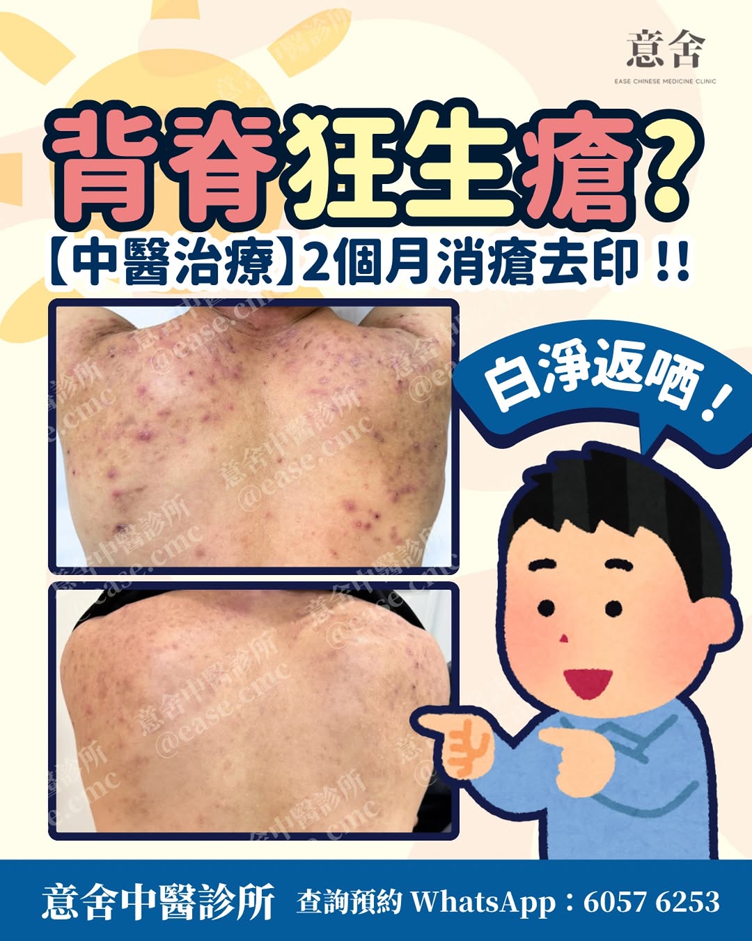 兩個月消瘡去印