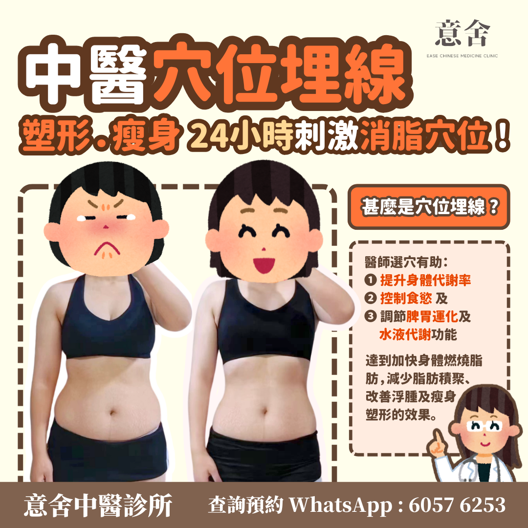 穴位埋線減肥案例