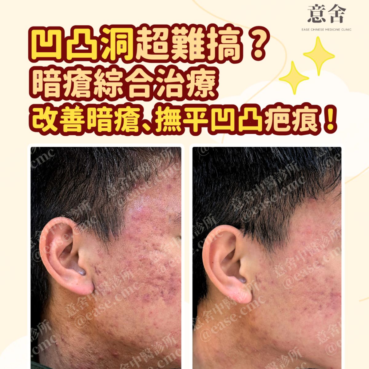 凹凸洞 中醫