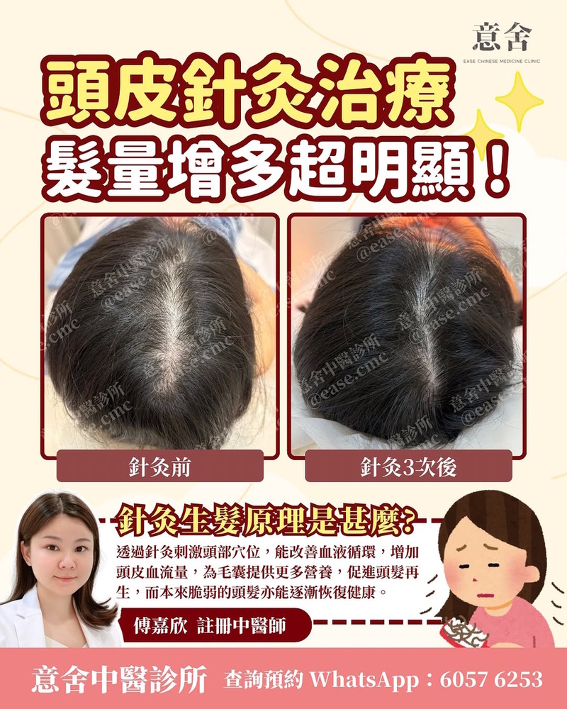 頭皮針灸案例 頭皮針灸案例