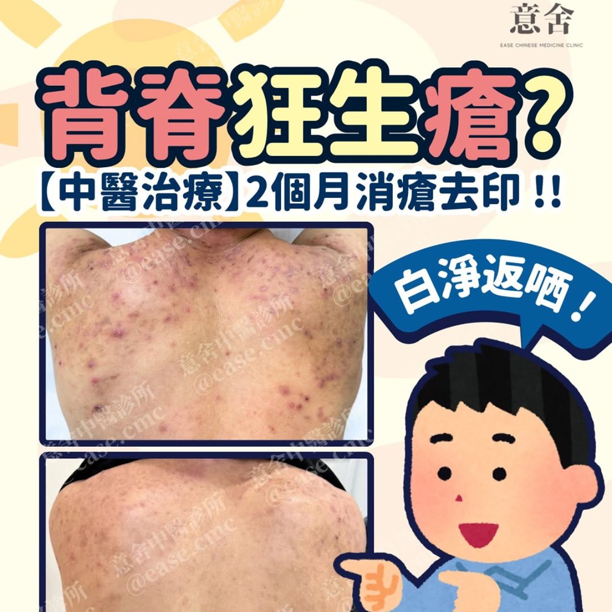 背部生暗瘡