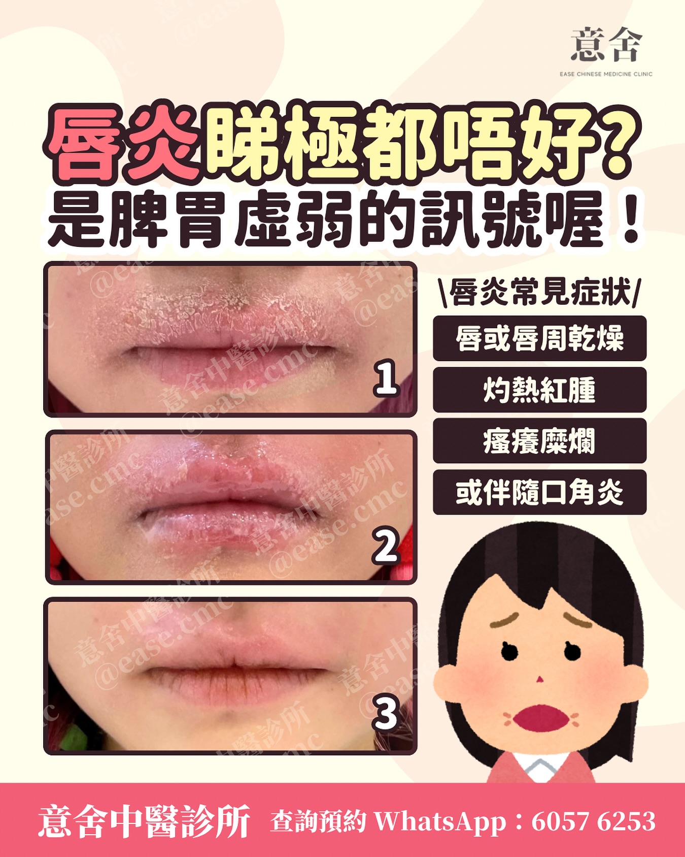 中醫治療唇炎案例