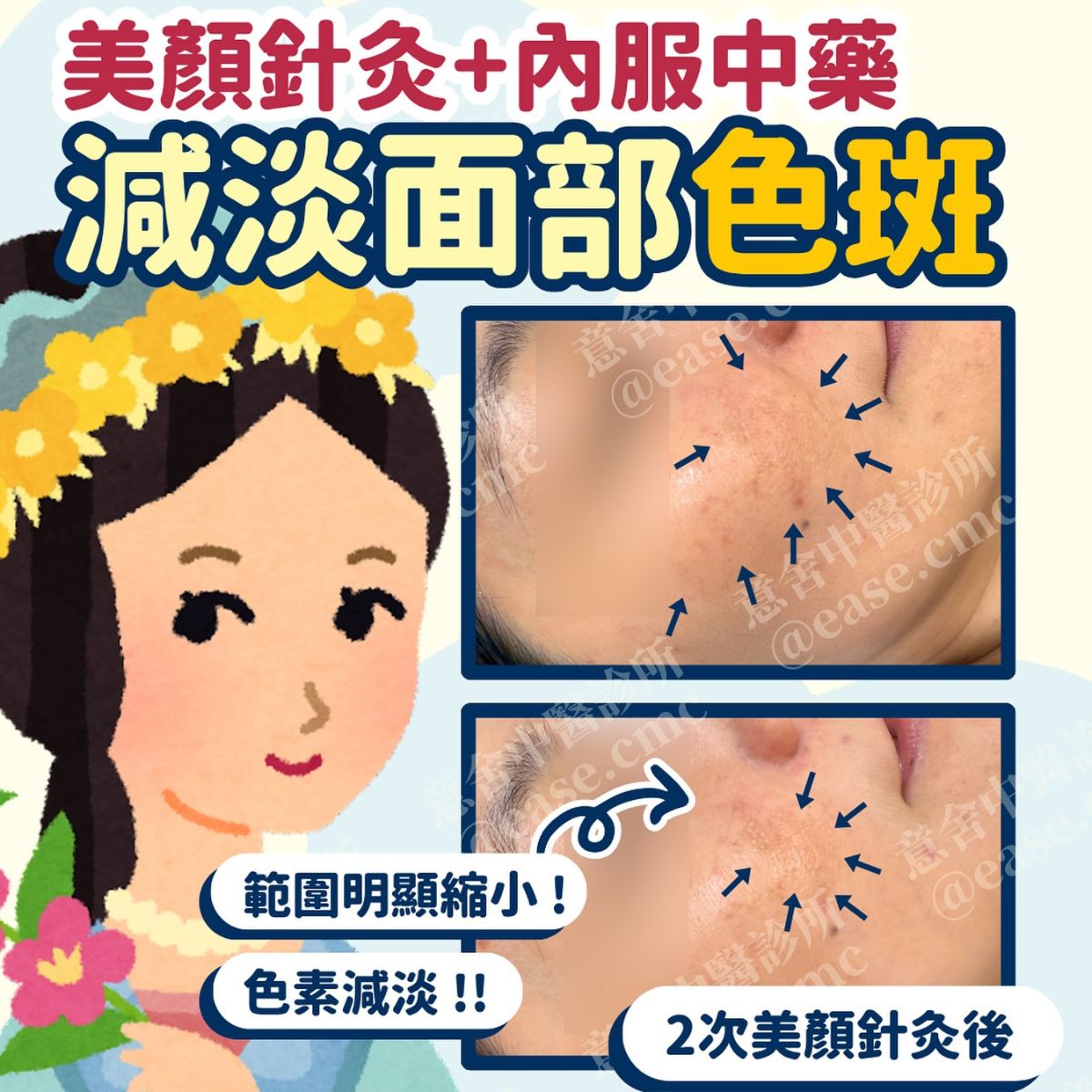 黃褐斑病案分享