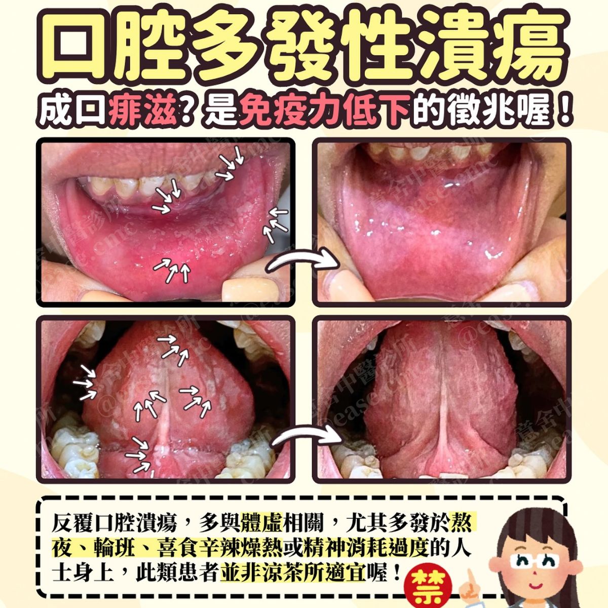 口腔多發性潰瘍