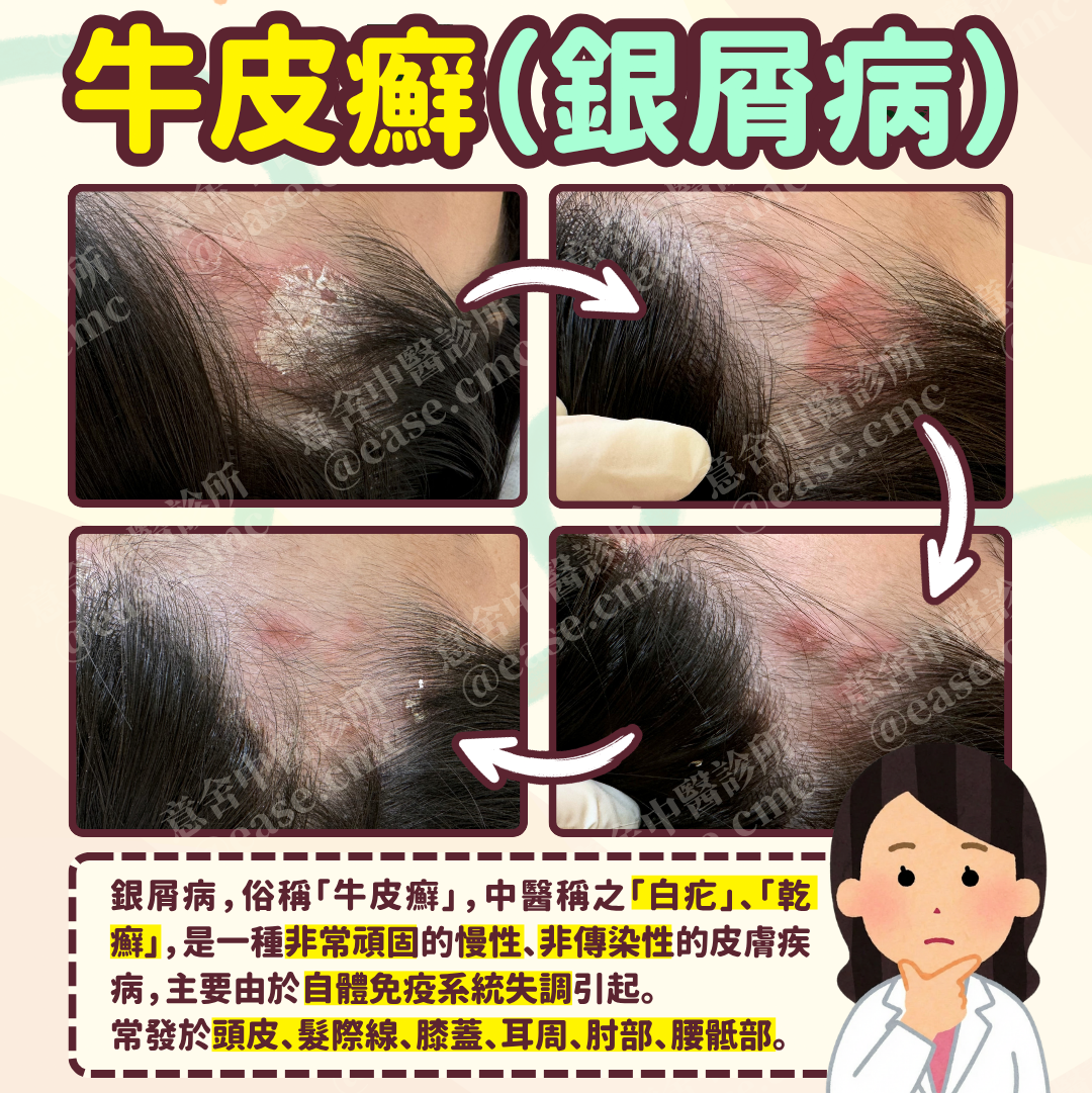 牛皮癬 銀屑病