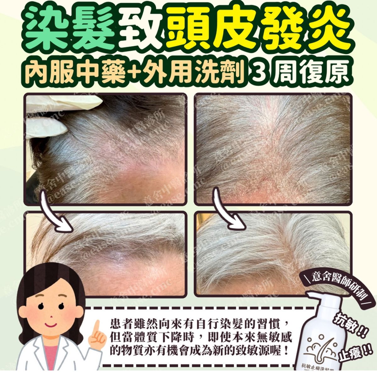 染髮致頭皮發炎