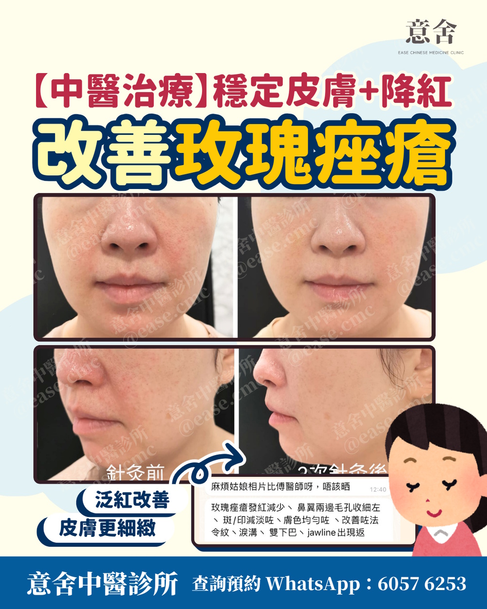 牛皮癬 銀屑病