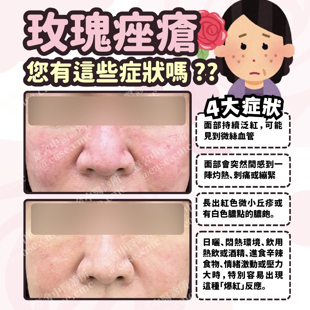 FU 玫瑰痤瘡